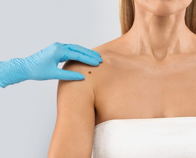 The doctor's gloved hand checking mole nevus on unrecognizable woman's shoulder, isolated on grey studio background. The concept of moles and skin cancer concept, cropped